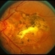 Old Presumed Ocular Histoplasmosis Syndrome